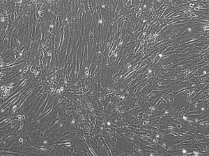 Human Ovarian Carcinoma Cancer-Associated Fibroblasts (CAFs): 1,000,000 Cells