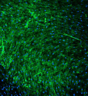 Human Melanoma Cancer-Associated Fibroblasts (CAFs): 1,000,000 Cells